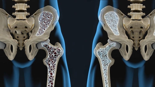 Qué Es La Osteoporosis Y Cómo Tratarla