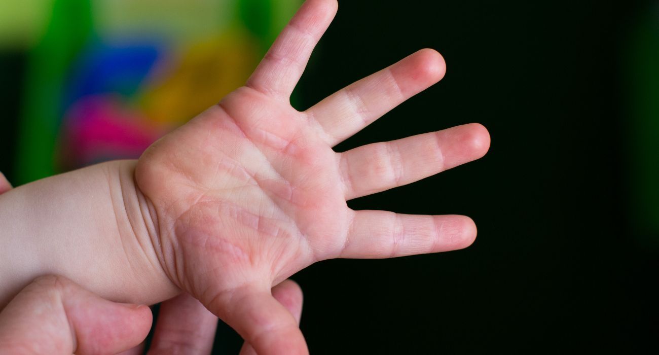 Descubre qué es la clinodactilia en niños, sus síntomas y las opciones de tratamiento disponibles en Clínica Osten.