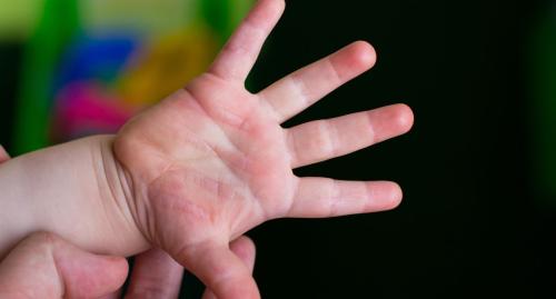 Clinodactilia en niños: causas, efectos y tratamientos recomendados