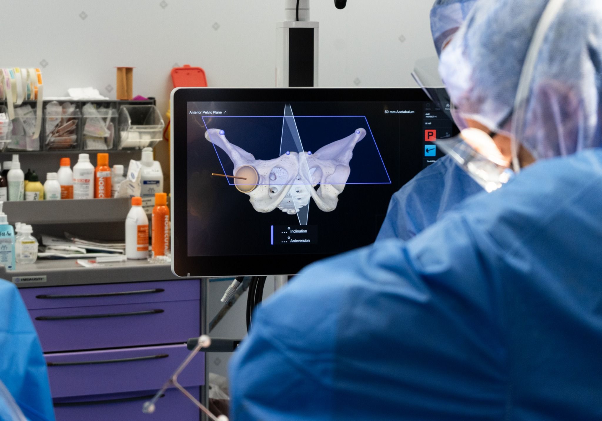 Cirujano utilizando tecnología robótica CORI durante una intervención de cadera con visualización 3D en tiempo real, mejorando la precisión quirúrgica.